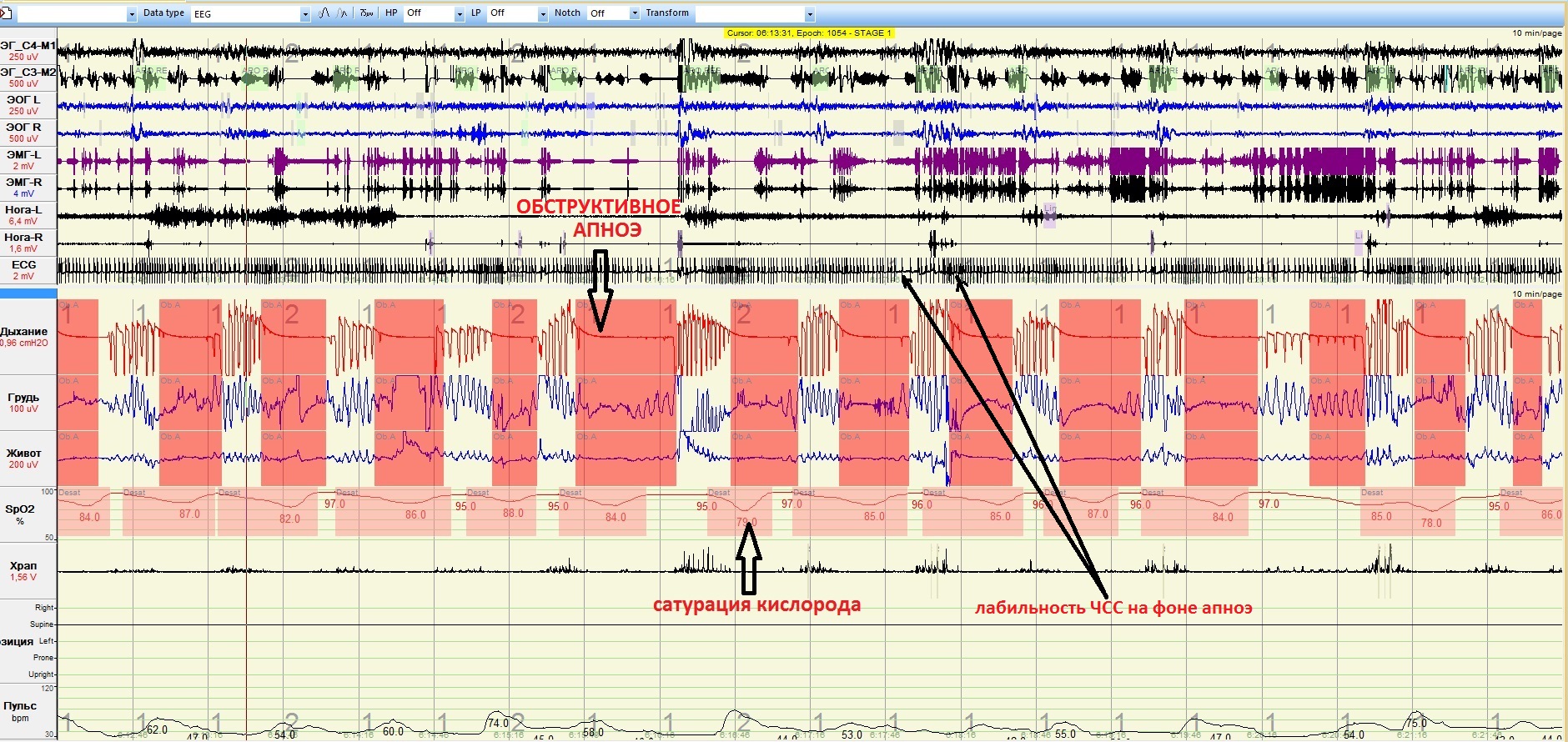 Kompleksn_apnoe_diagnostika1.jpg